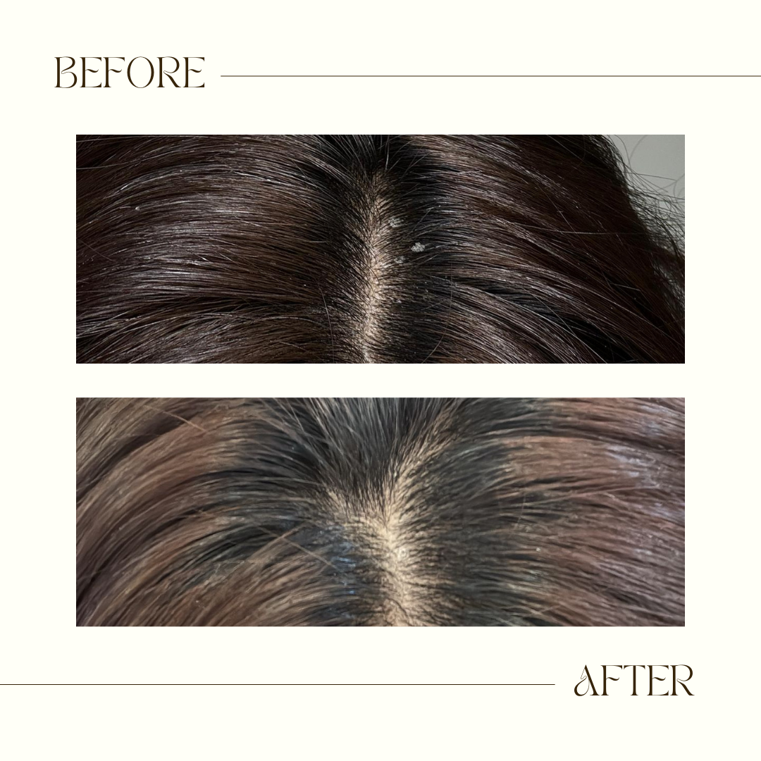 ScalpVeda Anti-Dandruff Hair Oil