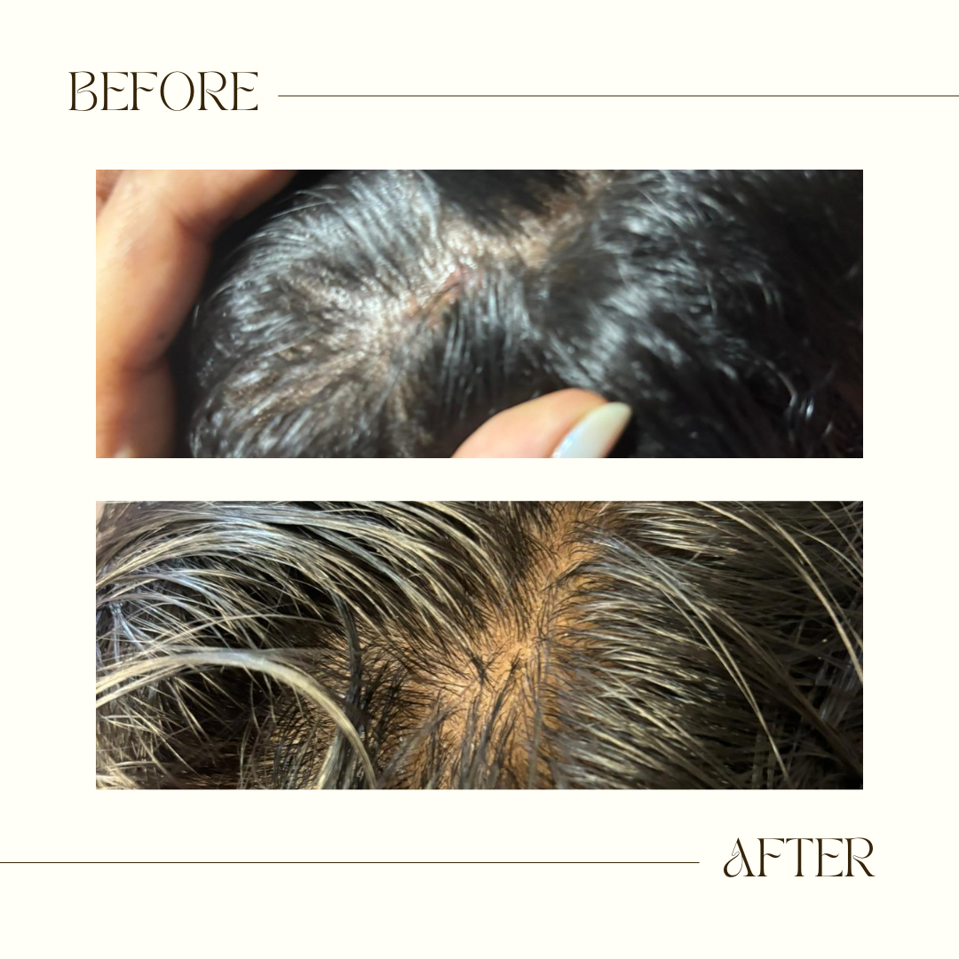 ScalpVeda Anti-Dandruff Hair Oil