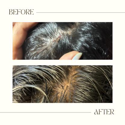 ScalpVeda Anti-Dandruff Hair Oil